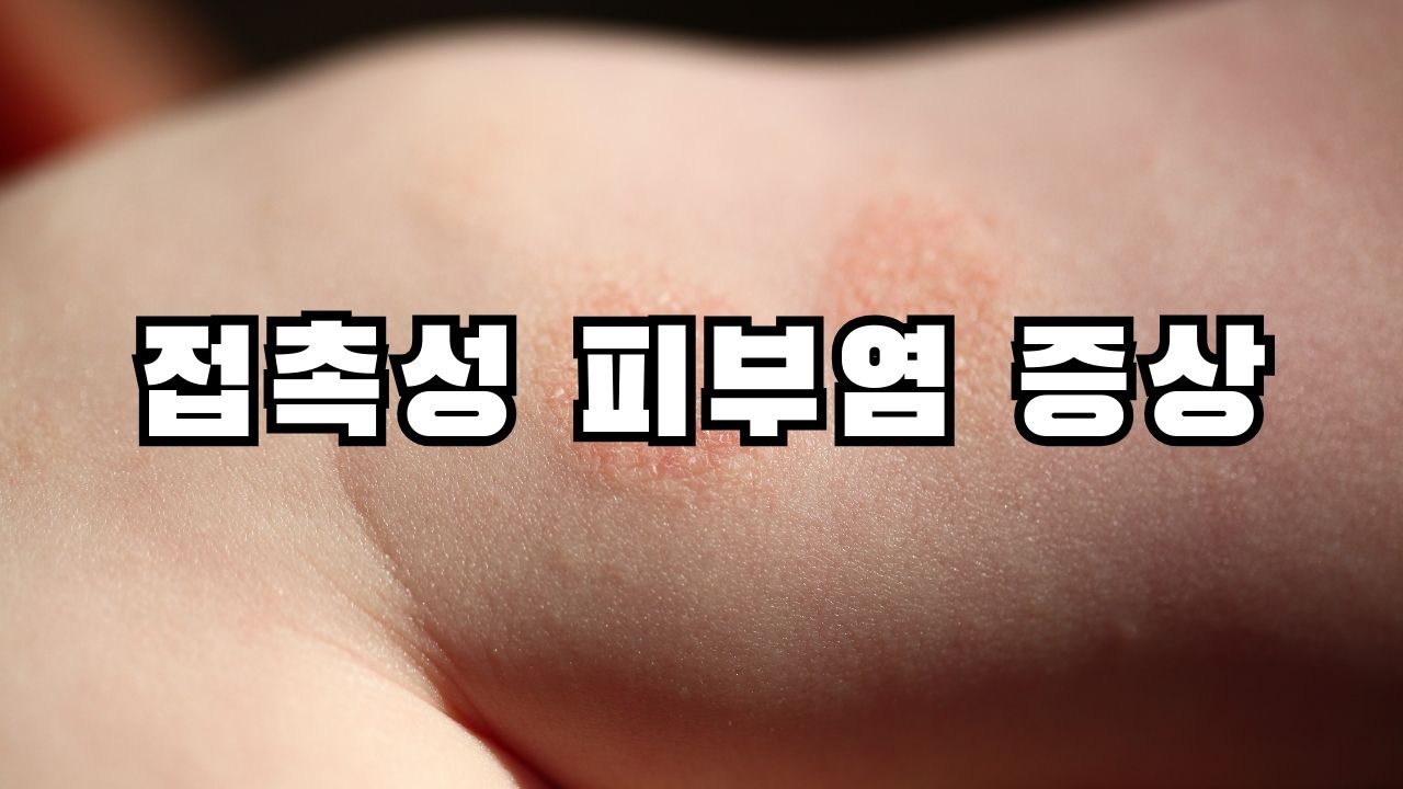 접촉성 피부염 증상