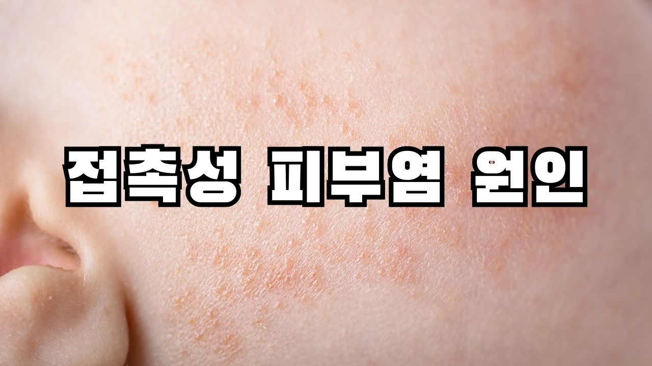 접촉성 피부염 원인